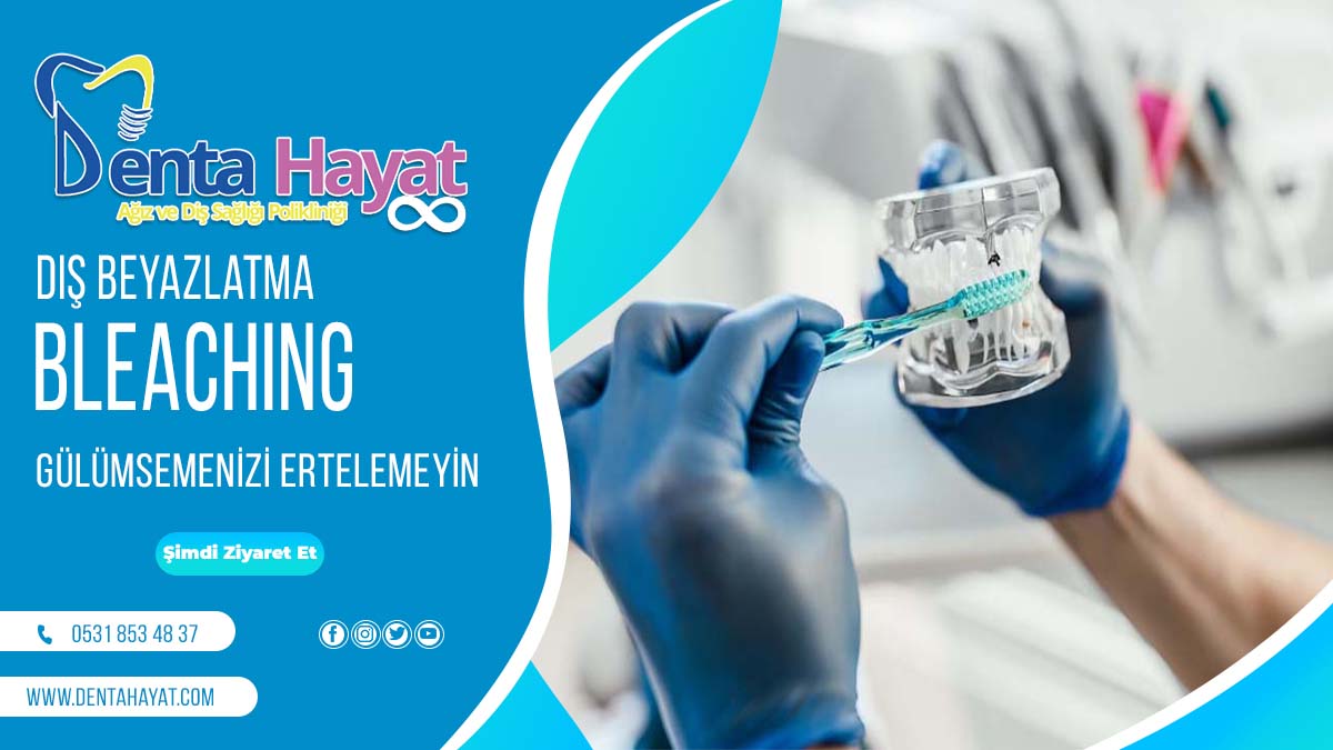Elazığ Diş Beyazlatma – Bleaching