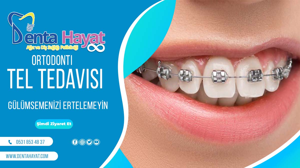 Ortodonti-tel-tedavisi